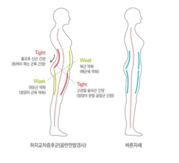 코어근육 무너진 사람들 특